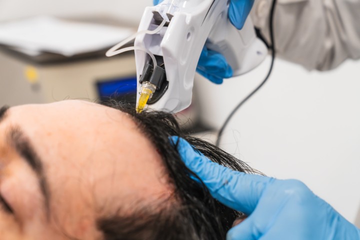 Medical professional in blue gloves uses a handheld needle-based device on a patient’s scalp during a procedure.